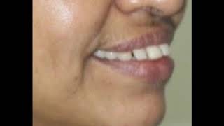 Dr Dharmesh H S Geetha Dental Clinic 9845338403 wwwalignersbracescom [upl. by Alvan]