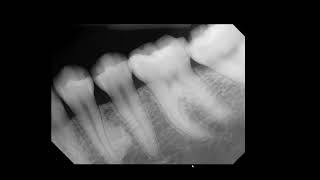 Idiopathic osteosclerosis [upl. by Seidel]