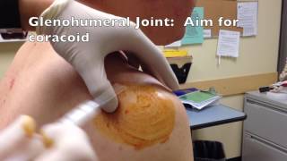 Glenohumeral shoulder Injection  Posterior Approach [upl. by Ocirnor]