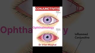 Conjunctivitis  Pink Eye  Sore Eye  Acute and Chronic Conjunctivitis  Dr Irfan Mughal [upl. by Iow]