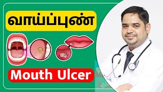 வாய்ப்புண்  Mouth Ulcer in tamil  Dr Abisheik Johnson Babu  Trinity Dental Clinic  Trichy [upl. by Lauryn]