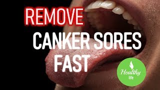 💋CANKER sores Get RId of them FAST Use🌿 NATURAL remedies [upl. by Ynnoj]