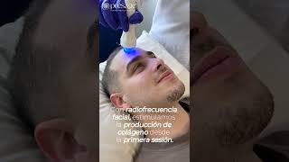 Radiofrecuencia Facial Hombres [upl. by Aztirak]