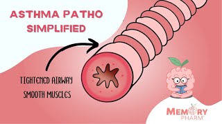 Asthma Pathophysiology Super Simplified [upl. by Faro73]