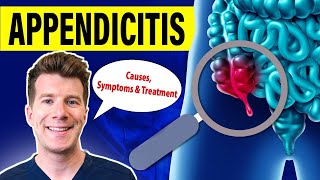 Doctor explains APPENDICITIS  Causes symptoms and treatment [upl. by Fernando803]