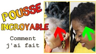 Tempes Comment jai fait repousser mes cheveux des TEMPES  Méthode 100 naturelle alopeciepousse [upl. by Jameson588]