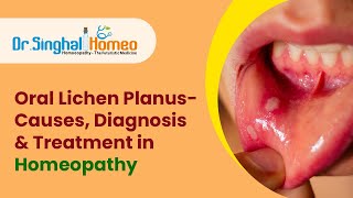 Best Homeopathic Treatment for Lichen PlanusDr Singhal homeo [upl. by Celene857]