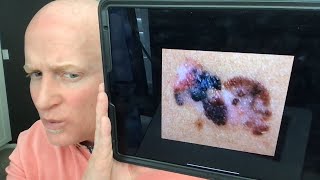 Malignant Melanomain depth discussion about a deadly skin cancer [upl. by Daggna]