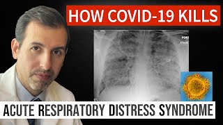 How Coronavirus Kills Acute Respiratory Distress Syndrome ARDS amp COVID 19 Treatment [upl. by Kappenne220]