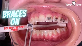 How do they put braces on  Tooth Time Family Dentistry New Braunfels [upl. by Hurty]