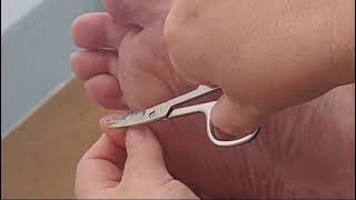 Subscribe for more videos callus cutting saga little toe subscribe for more videos [upl. by Barcot]