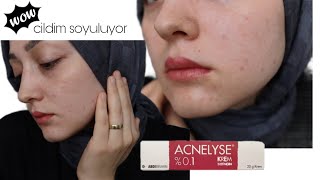 Acnelyse Krem Kullanımı  3 ve 4 Gün  Cildim Soyulmaya Başladı 😯 [upl. by Hassett]