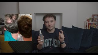 18 Months of topical finasteride and minoxidil my thoughts hims [upl. by Arok611]