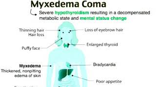 Myxedema comahypothyroidism [upl. by Pelaga]