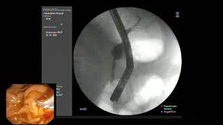 ERCP  Papillitis from recently passing CBD stone [upl. by Dale]