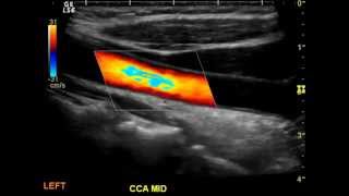 Normal Carotid Duplex [upl. by Oinimreh60]