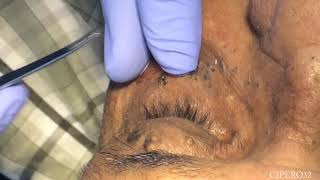 Milia  Stringoma Removal  Periorbital Area [upl. by Raleigh]