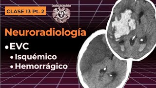 132  Neuroradiología EVC isquémico y hemorrágico [upl. by Yendic]