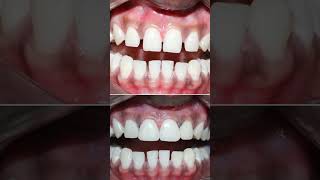 Front teeth gap filling magic in one day shorts [upl. by Frear]