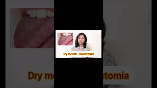 Bad breath Halitosis and its causes by drnavzdentist part 2 youtubeshorts badbreath [upl. by Gorlin]