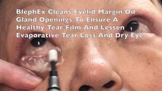 BlephEx Eyelid Treatment For Dry Eyes Blepharitis by Dr Burroughs in Colorado Springs [upl. by Yle81]