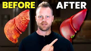 How to Fix Your Fatty Liver at Home5 Tips [upl. by Lida]