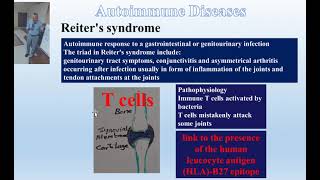 Musculoskeletal autoimmune disorders [upl. by Kai]