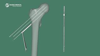 Double Medical 73mm Cannulated Screw [upl. by Aihsemaj]