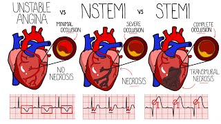 Acute Coronary Syndrome Heart Attack  Unstable Angina vs NSTEMI vs STEMI  With ECGs [upl. by Hsihsa]