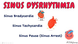 Sinus dysrhythmia  Tachycardia bradycardia and sinus pause [upl. by Reffineg]