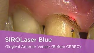 SIROLaser Blue  Gingival Troughing Anterior Veneer Before CEREC [upl. by Prendergast]