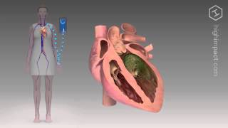 Endocarditis  Proper Antibiotic [upl. by Fallon]