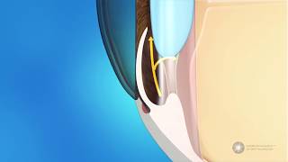 What is angleclosure glaucoma [upl. by Noerb]