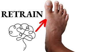 Get Rid Of Bunions For Good Nervous System Retraining [upl. by Hanimay]