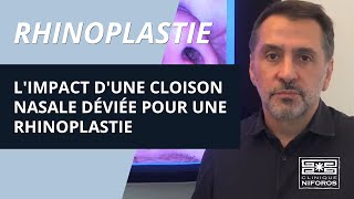 Limpact dune cloison nasale déviée pour une rhinoplastie [upl. by Nethsa761]