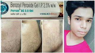 100 Acne cure with Benzoyl Peroxide india [upl. by Noell]