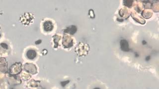 Spirochetes in Urine [upl. by Adnauqahs]