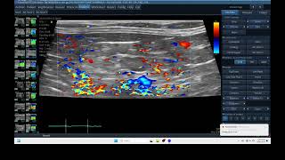 IQ 284 MESENTARY LYMPHOID NODE ENLARGEMENT GI BLEEDING ULTRASOUND ECHOPAC ANALYSIS 2 [upl. by Iila]