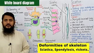 Deformities of skeleton part 02  Disc Slip  Spondylosis  Sciatica  Arthritis [upl. by Packston712]