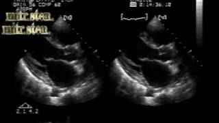 RHD with mild mitral leaflets fibrosis without significant stenosis [upl. by Muraida]