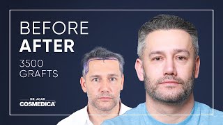 Hair Transplant in Turkey  Results  Dr Acar  Cosmedica Clinic [upl. by Newo]