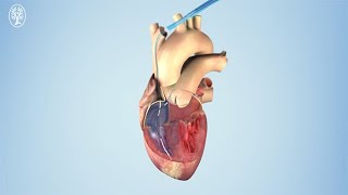 Implantation eines Implantierbaren Cardiovertern Defibrillators ICD [upl. by Rodrigo]