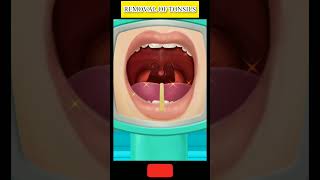 Removal of tonsils tonsilitis tonsils tonsilstones facts [upl. by Nnylaj575]