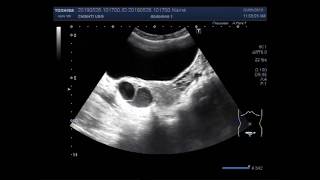 Ultrasound Video showing difference between the simple and hemorrhagic ovarian cysts [upl. by Nnylyrehc975]