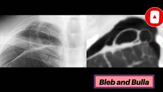 Blebs and Bullae radiology thoracicsurgery pulmonology [upl. by Sible]