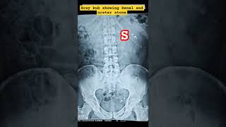 X ray KUB  Renal and ureteric stones [upl. by Gentry]