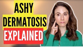 DERMATOLOGIST EXPLAINS ASHY DERMATOSIS WHAT IS IS AND HOW TO TREAT IT [upl. by Kciremed]