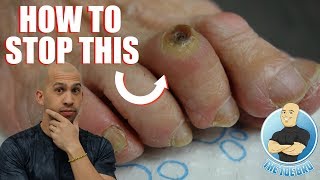 FOOT CORN REMOVAL FULL TREATMENT  FOOT HEALTH MONTH 2018 3 [upl. by Ayotel]