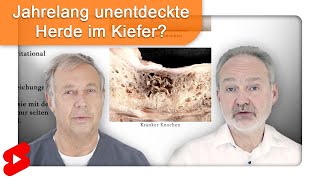 Fäulnis und Entzündung im Kieferbereich  was sind NICOs Shorts [upl. by Ute]