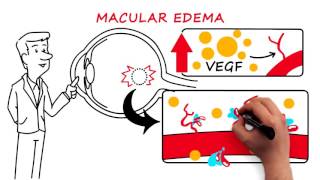 Retinal Vein Occlusion [upl. by Neimad131]